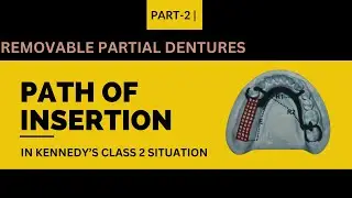 Understanding Path of Insertion in Kennedy's Class 2 Situations