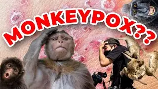 Monkeypox? A Doctor Explains