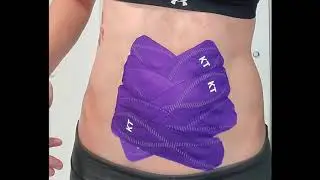 Taping for diastasis recti: criss cross method | Connect PT