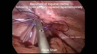 Laparoscopic repair of recurrent inguinal hernia after open repair.