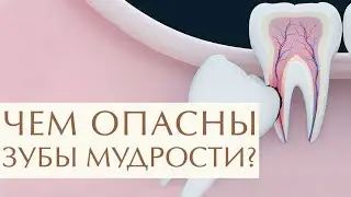 🤔 Для чего нужны зубы мудрости, стоит или нет их удалять. Удалять или нет зуб мудрости. 12+