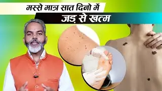 हफ्ते भर में गर्दन के मस्से हो जायेंगे गायब ये तरीका अपनाओ | Gardan Ke Masse Kaise Hataye