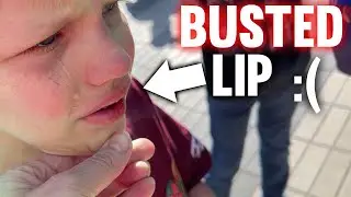 Michael Busted His Lip 😥