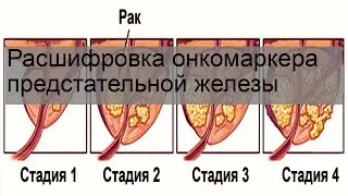 Расшифровка онкомаркера предстательной железы