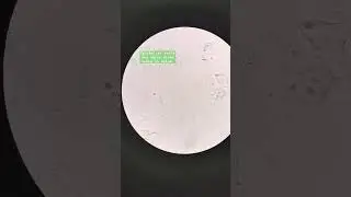 Epithelial cells in urine under the microscope