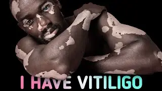 Living With Vitiligo: Can It Be Cured?