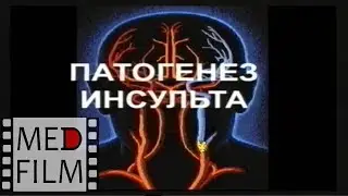 Pathogenesis of stroke ©
