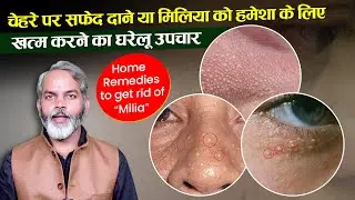 गर्मी में चेहरे पर निकलने वाले सफेद दाने या मिलिया के लिए घरेलू उपाय | Home Remedies for Milia