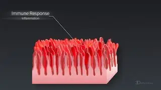 What is Celiac Disease? - World Digestive Health Day