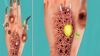 ASMR Mencabut Bel4tung Yang Bersarang Pada Tangan