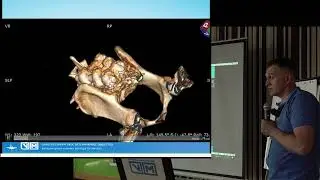 Транспедикулярный фиксаторы Усть Каменногорск