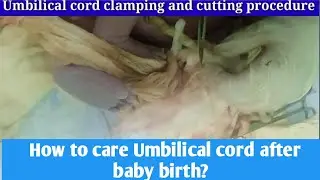 Umbilical cord clamping and cutting procedure