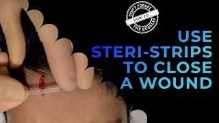 How to apply steri-strips to a laceration - wound closure (butterfly)