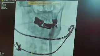 Причина инсульта