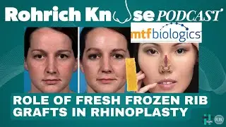 Role of Fresh Frozen Rib Grafts in Rhinoplasty