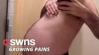 Transgender man's 'pregnant belly' turns out to be a huge ovarian tumor | SWNS