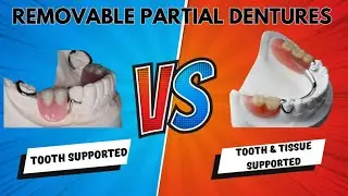 TOOTH SUPPORTED VS. TOOTH & TISSUE SUPPORTED REMOVABLE PARTIAL DENTURES