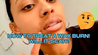 HOW TO TREAT A WAX BURN(WILL IT SCAR?)