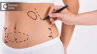 Are the effects of Liposuction permanent? - Dr. Srikanth V