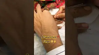 Acupuncture📌FingerTop👌🤚 #acupuncture #tcm #dr #viral #trending #shorts #nerveproblem #finger
