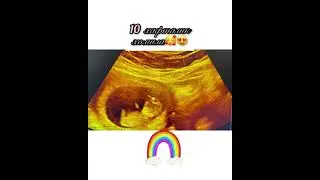10 хафталик хомила🥰😍