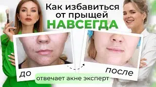 КАК ВЫЛЕЧИТЬ ПРЫЩИ | Нужны ли ретиноиды, шлифовка, пилинги? Отвечает врач дерматолог 