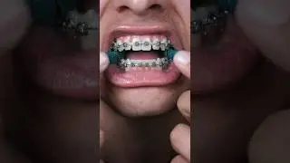 Blue Takis Vs. Braces 