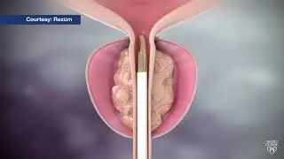 Mayo Clinic Minute: Steam treatment for enlarged prostate