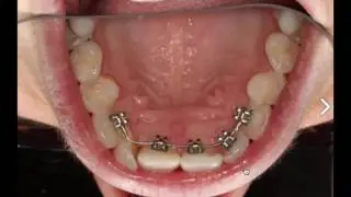 How to Straighten Teeth with Invisible Braces