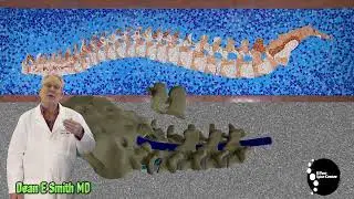 What Is a Lumbar Laminectomy?