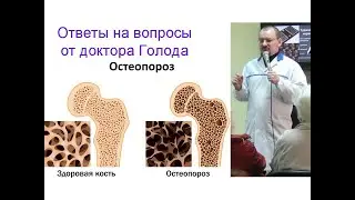 Остеопороз – ответ от доктора Голода