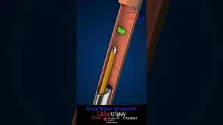 Kidney stone removal - Lithotripsy procedure