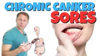 Dealing with Chronic Canker Sores