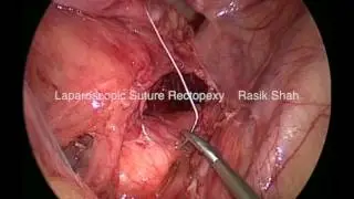 Laparoscopic Suture Rectopexy for Rectal Prolapse by Rasik Shah.
