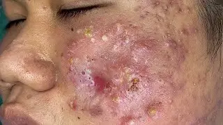 Espremendo Cravos e Espinhas - Relaxante e Satisfatório 😍