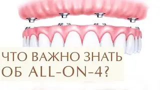 В каких случаях стоит выбрать систему имплантации зубов все на 4. Имплантация зубов все на 4. 12+