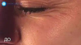 Лазер + SMAS + RF  Три самых эффективных аппарата по лицу