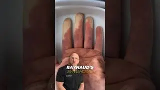More Than Just Pale Fingers and Toes - Raynaud’s Syndrome 