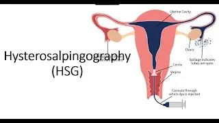 Hysterosalpingography