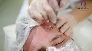 Три самых эффективных омолаживающих аппарата  2023