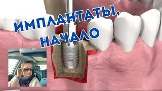 Имплантаты. Начало. Часть 1
