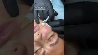 Кисетные морщины. Запись на все обучающие программы ➡️ inst:dr.antonina_guz