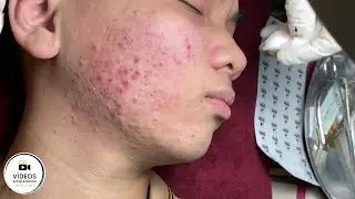 Acne Treatment | Very Satisfactory | Removal of blackheads and pimples 😍