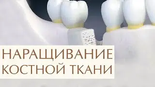 💉  Костная пластика челюстей при имплантации зубов. Костная пластика челюсти. Легкое Дыхание. 12+