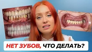 Не осталось ни одного зуба во рту / Что делать?  #стоматология #имплантациязубов