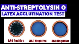 Anti-streptolysin O Latex Agglutination Test | |MEDICAL LABORATORY SCIENCE
