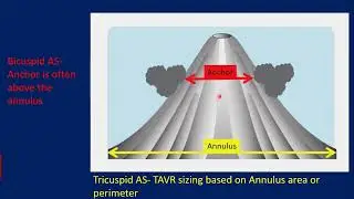 Updates on TAVR for Bicuspid Aortic Stenosis in 2022 | Yashasvi Chugh, MD