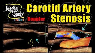 Carotid Artery Stenosis || Ultrasound || Doppler || Case 246