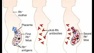 Erythroblastosis Fetalis