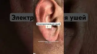 Электроэпиляция зоны ушей. Результат через несколько процедур 👂🏼⚡️
